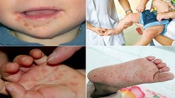 Hơn 43.000 người mắc bệnh tay chân miệng, Bộ Y tế chỉ đạo khẩn