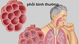 Ðau ở ngực – Không chỉ mỗi bệnh tim