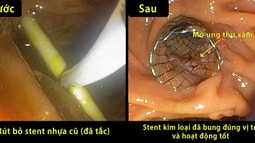 Đặt Stent đường mật cứu sống bệnh nhân ung thư giai đoạn cuối